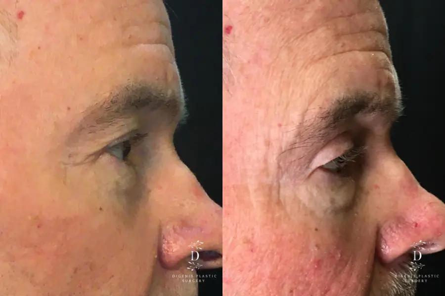 Eyelid Surgery: Patient 19 - Before and After 3