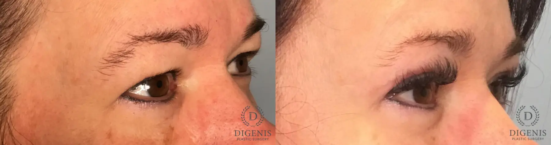 Eyelid Surgery: Patient 1 - Before and After 3