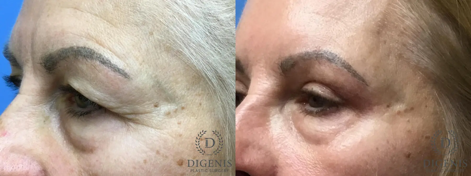 Eyelid Surgery: Patient 6 - Before and After 4