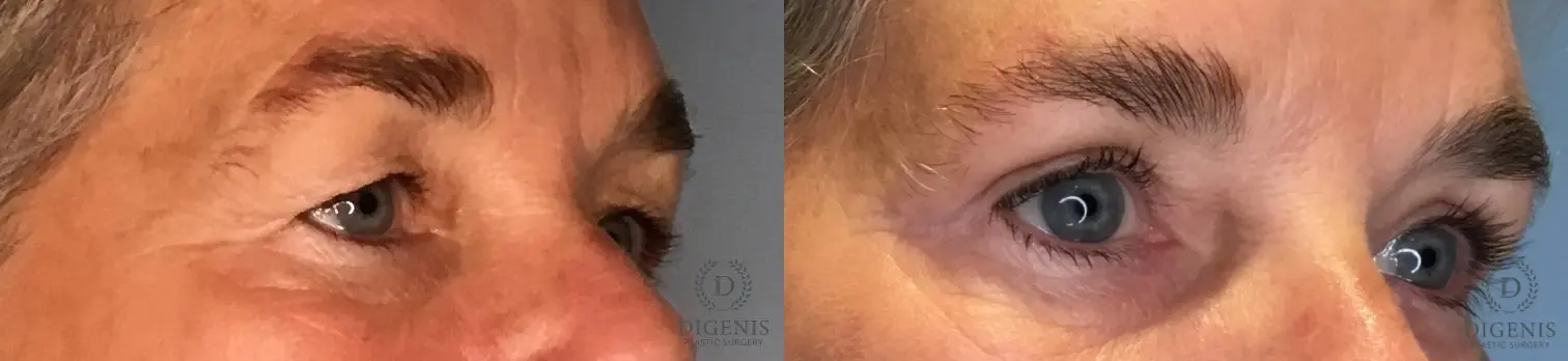Eyelid Surgery: Patient 76 - Before and After 2