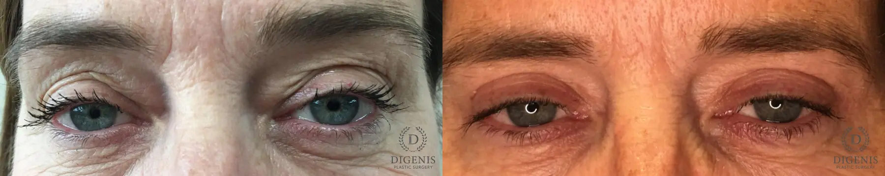 Eyelid Surgery: Patient 60 - Before and After 2