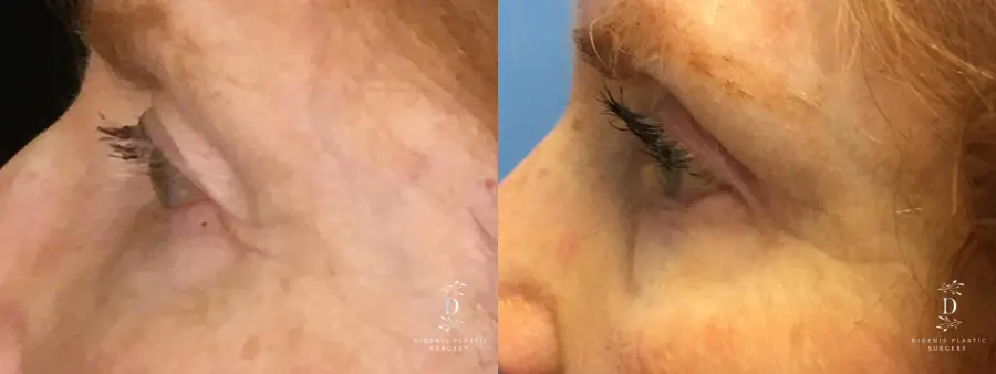Eyelid Surgery: Patient 15 - Before and After 5
