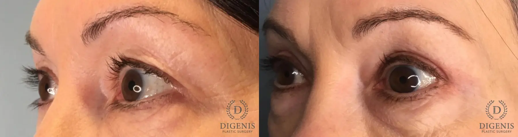 Eyelid Surgery: Patient 72 - Before and After 3