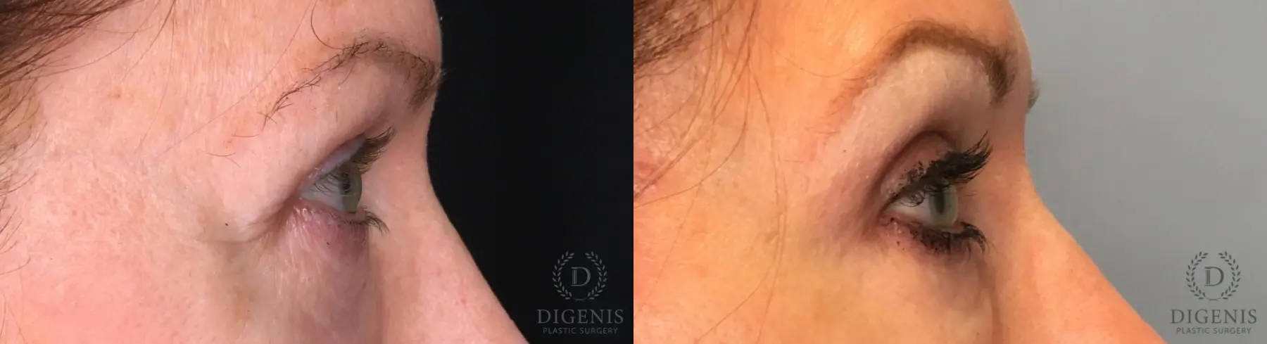 Eyelid Surgery: Patient 56 - Before and After 3