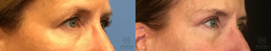 Eyelid Surgery: Patient 2 - Before and After 2