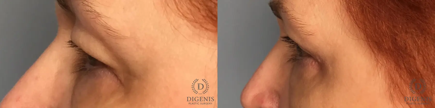 Eyelid Surgery: Patient 35 - Before and After 2