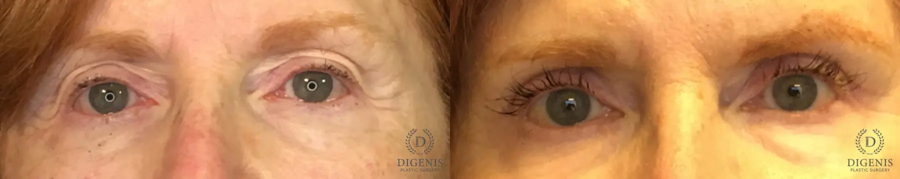 Eyelid Surgery: Patient 15 - Before and After  