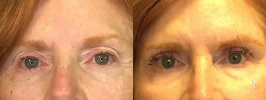 Eyelid Surgery: Patient 15 - Before and After 1