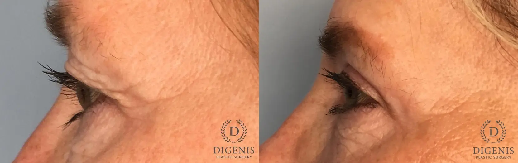 Eyelid Surgery: Patient 6 - Before and After 3
