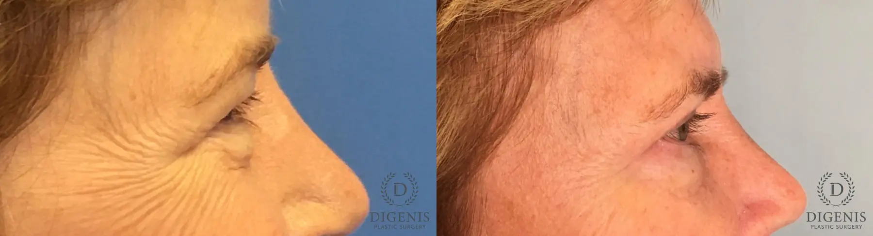 Eyelid Surgery: Patient 58 - Before and After 3