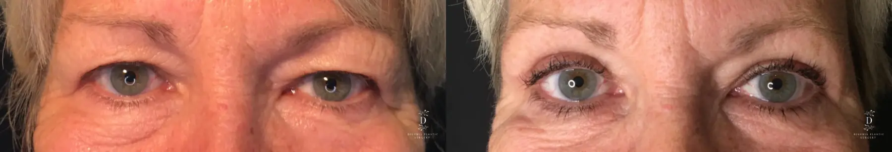 Eyelid Surgery: Patient 33 - Before and After 1