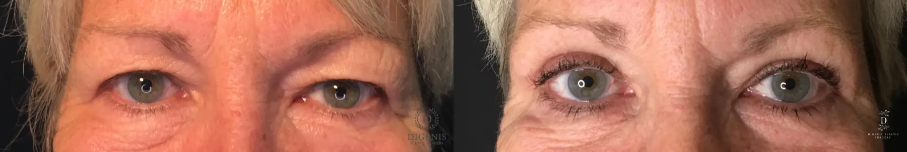 Eyelid Surgery: Patient 33 - Before and After  