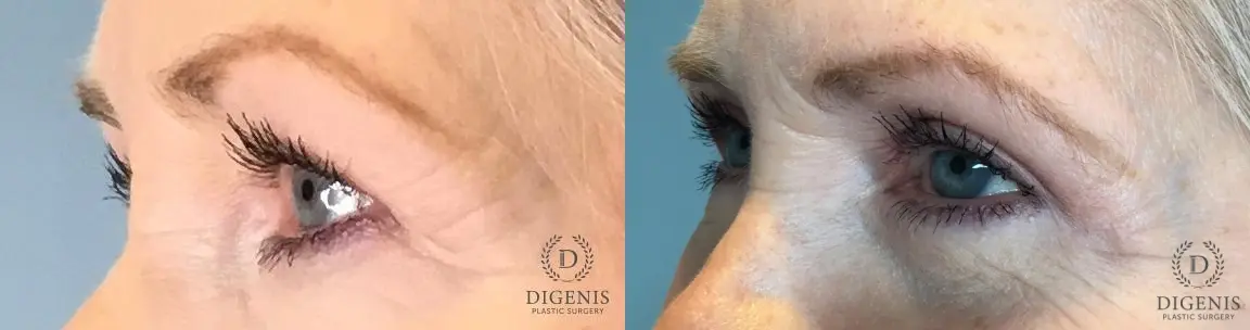 Eyelid Surgery: Patient 59 - Before and After 3