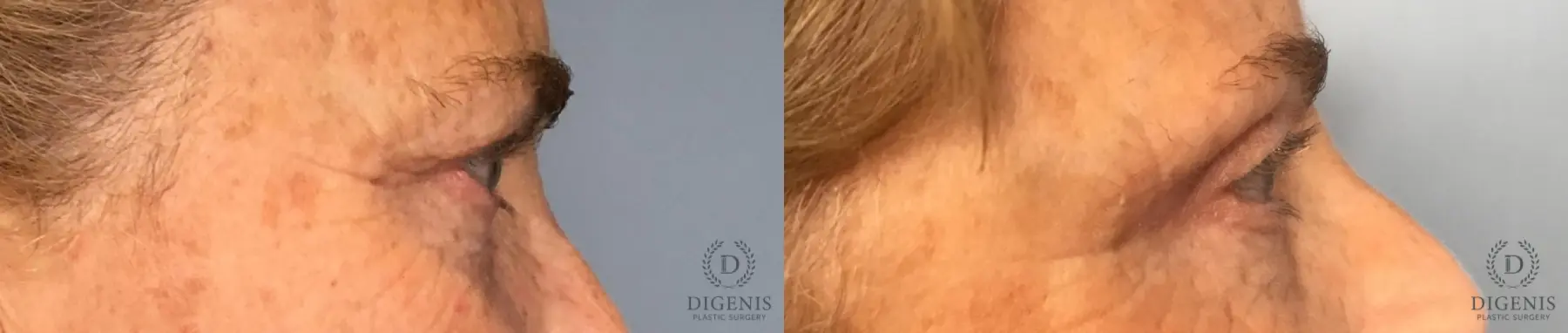 Eyelid Surgery: Patient 10 - Before and After 5