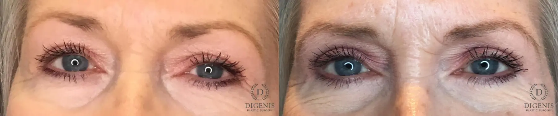 Eyelid Surgery: Patient 59 - Before and After  