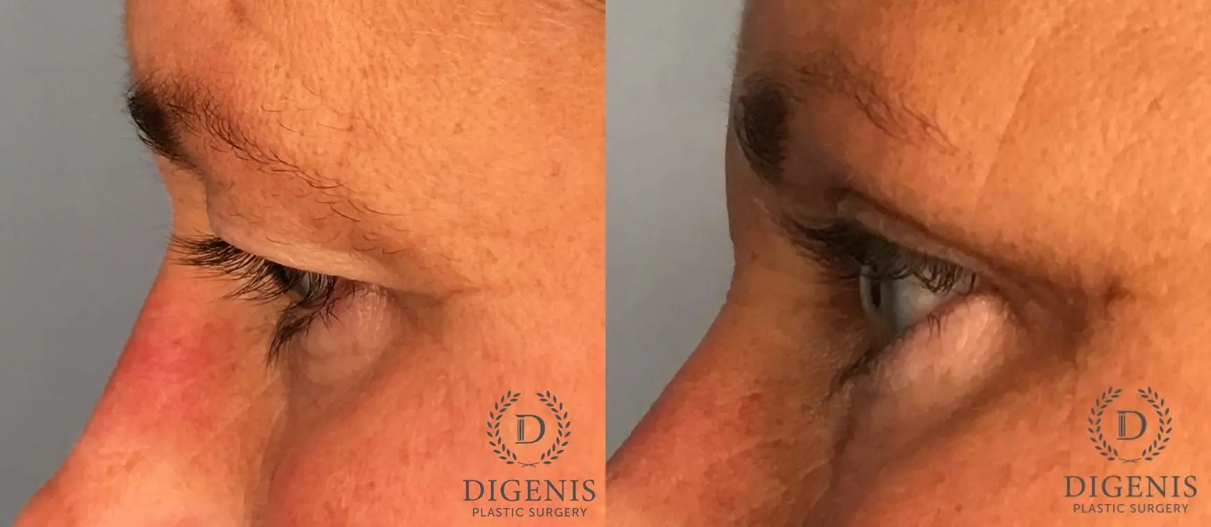 Eyelid Surgery: Patient 69 - Before and After 3