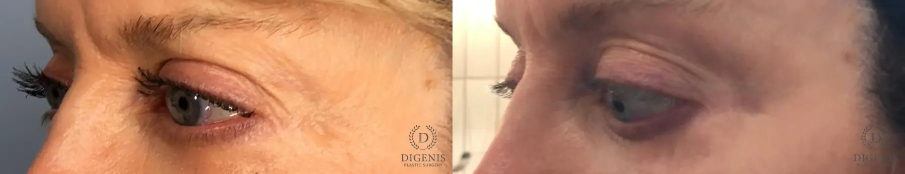 Eyelid Surgery: Patient 70 - Before and After 2