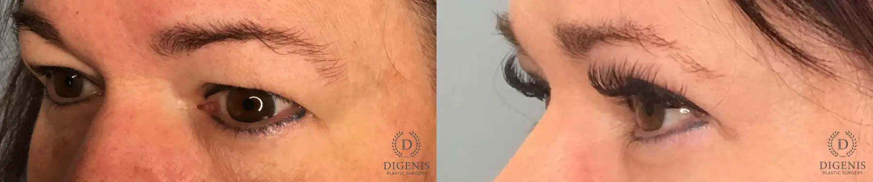 Eyelid Surgery: Patient 1 - Before and After 2