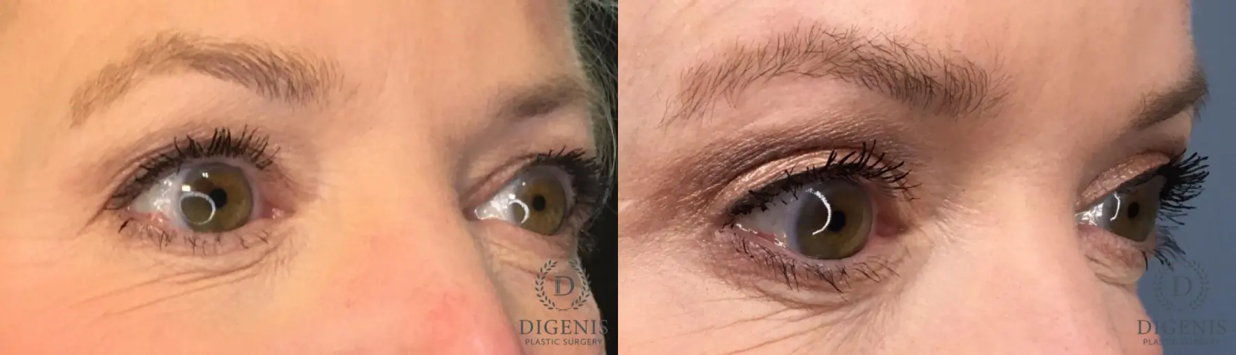 Eyelid Surgery: Patient 14 - Before and After 2