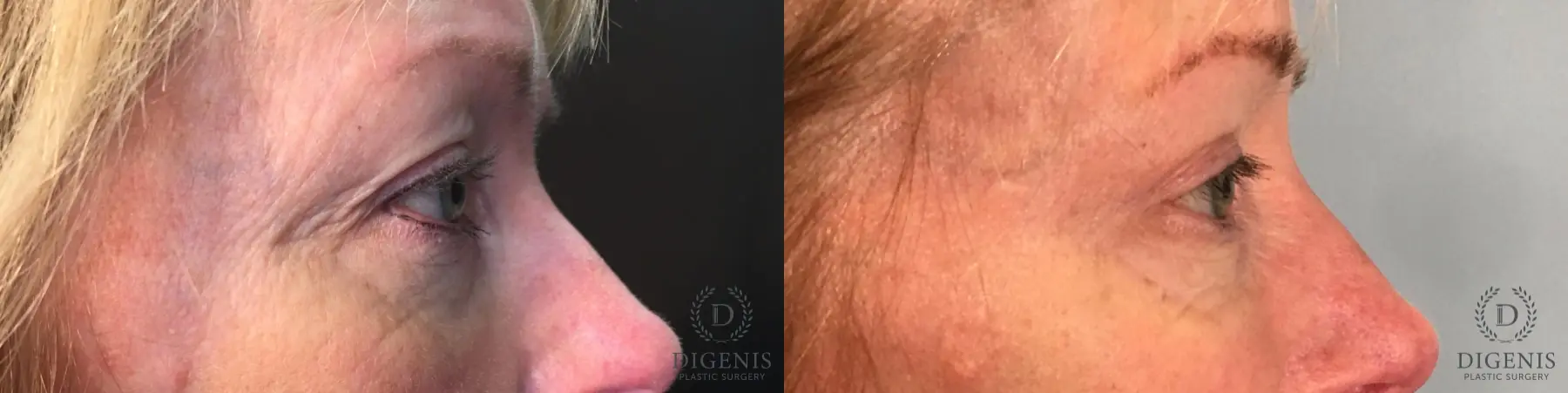 Eyelid Surgery: Patient 34 - Before and After 4