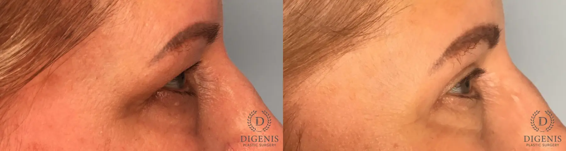 Eyelid Surgery: Patient 74 - Before and After 5