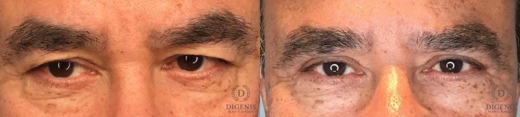 Eyelid Surgery: Patient 82 - Before and After  