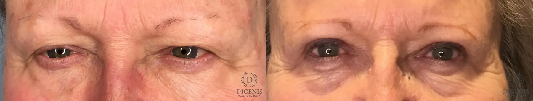Eyelid Surgery: Patient 75 - Before and After 1