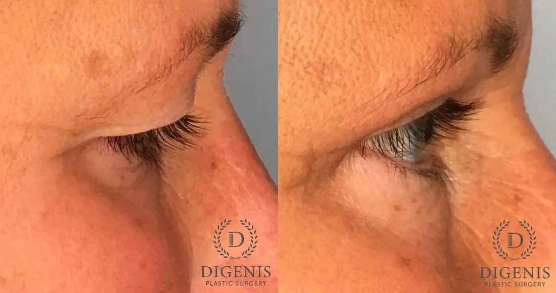 Eyelid Surgery: Patient 69 - Before and After 5