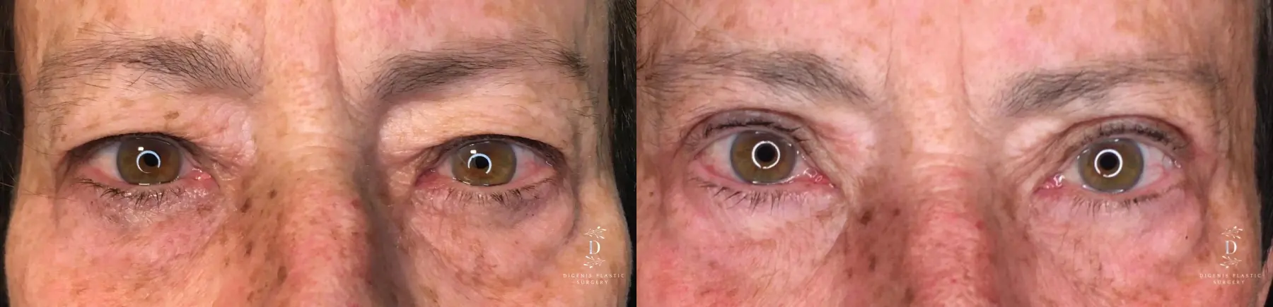 Eyelid Surgery: Patient 26 - Before and After  