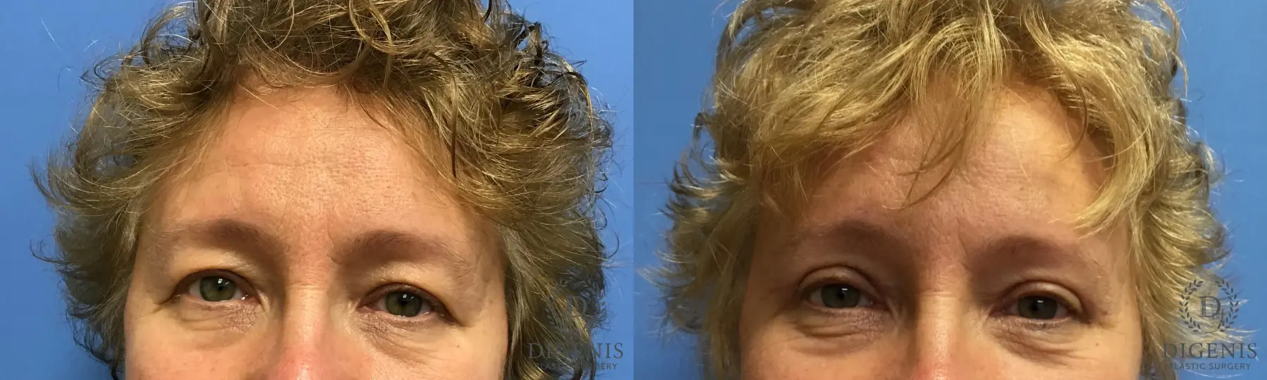 Eyelid Surgery: Patient 4 - Before and After 1
