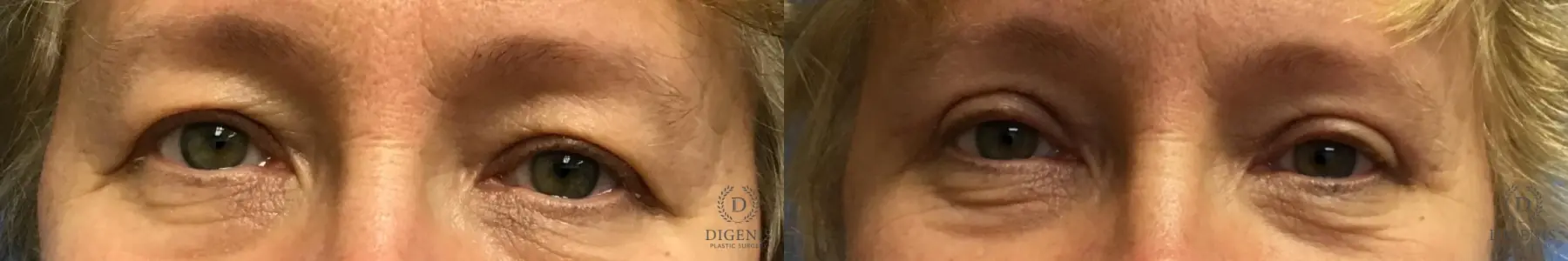 Eyelid Surgery: Patient 4 - Before and After  