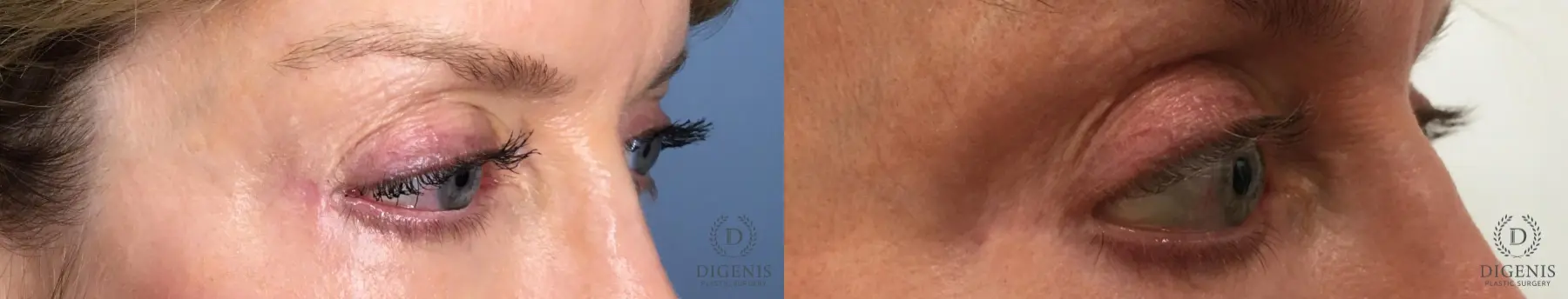 Eyelid Surgery: Patient 70 - Before and After 4