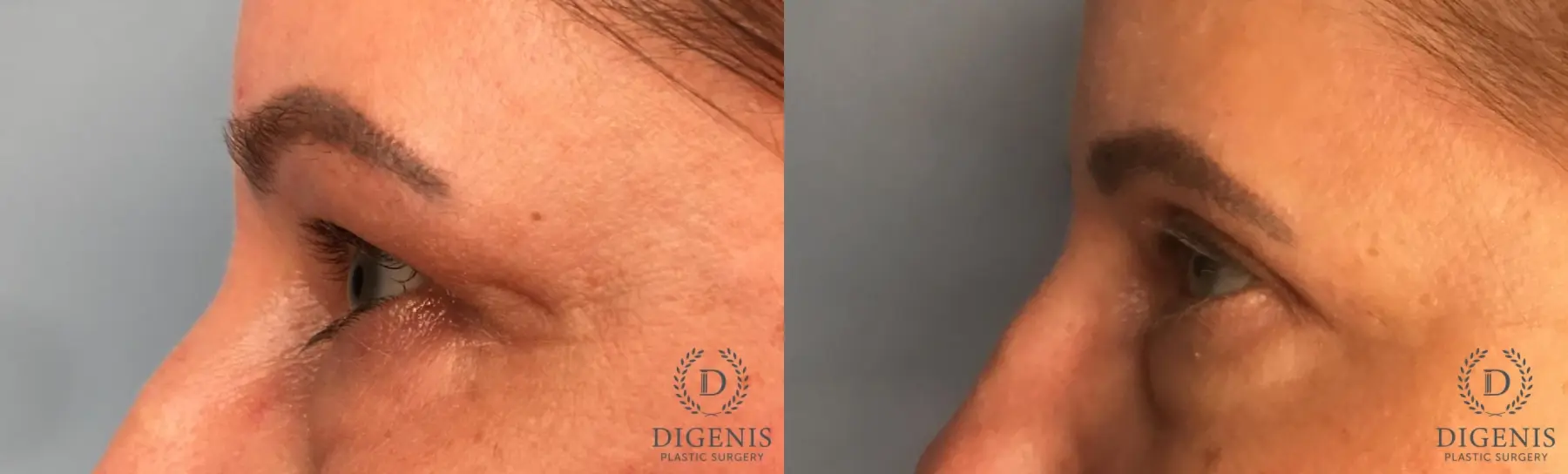 Eyelid Surgery: Patient 74 - Before and After 3