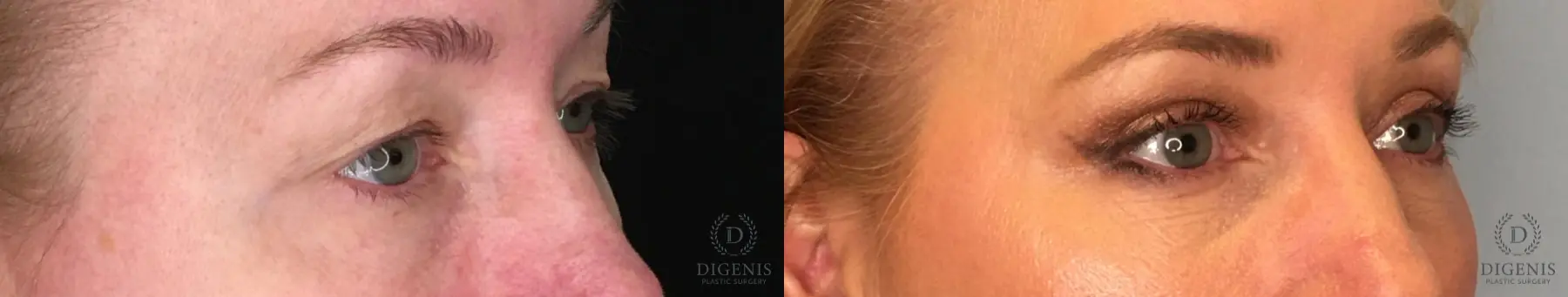 Eyelid Surgery: Patient 51 - Before and After 4