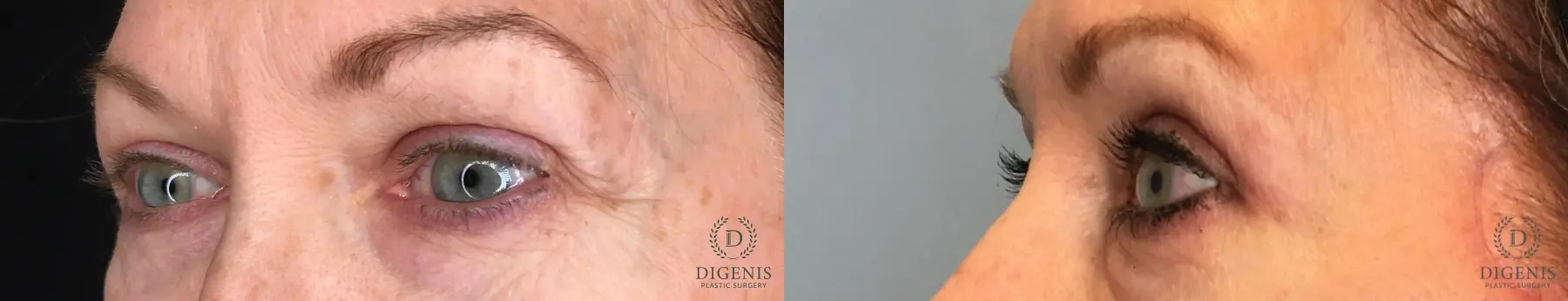 Eyelid Surgery: Patient 56 - Before and After 4