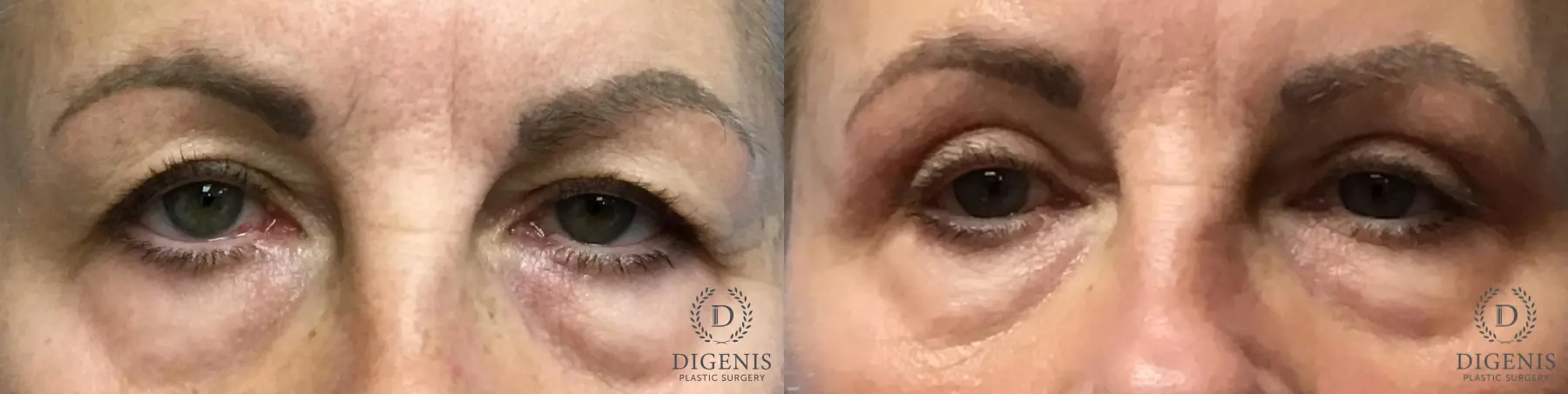 Eyelid Surgery: Patient 6 - Before and After  