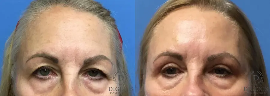 Eyelid Surgery: Patient 6 - Before and After 1