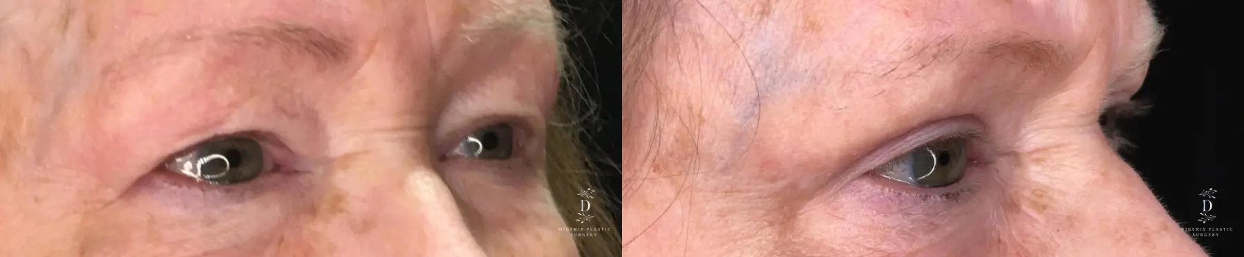 Eyelid Surgery: Patient 25 - Before and After 2