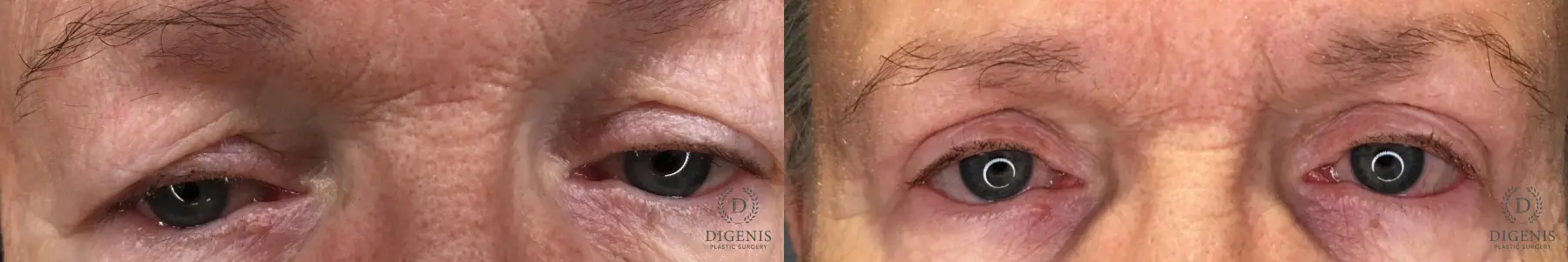 Eyelid Surgery: Patient 61 - Before and After 2