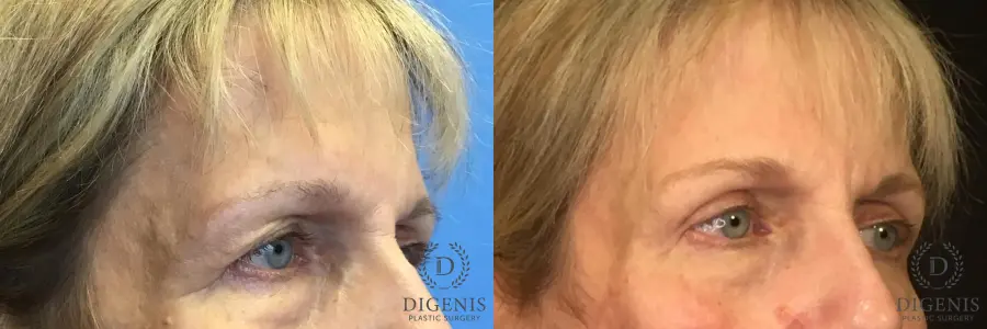 Eyelid Surgery: Patient 5 - Before and After 2