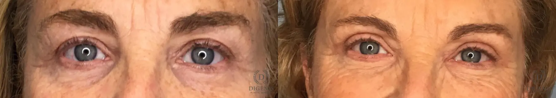 Eyelid Surgery: Patient 10 - Before and After  