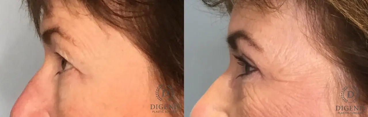 Eyelid Surgery: Patient 73 - Before and After 4