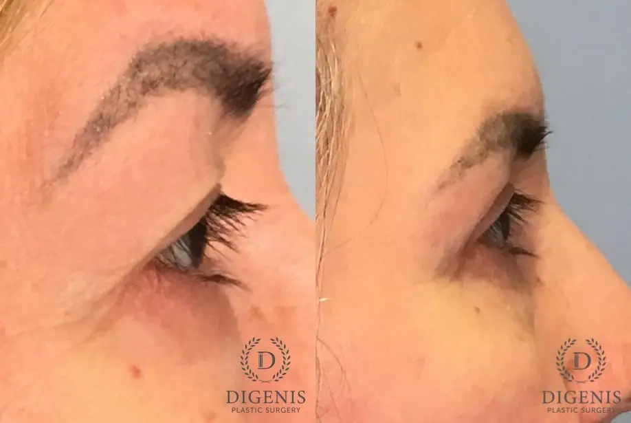 Eyelid Surgery: Patient 67 - Before and After 5