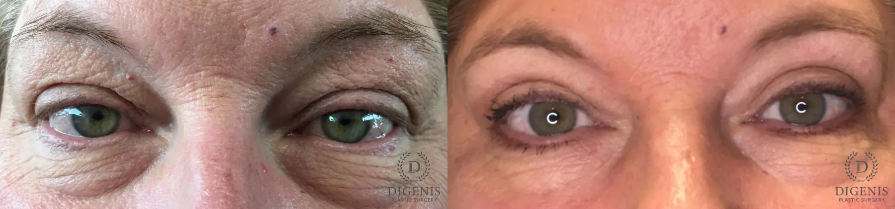 Eyelid Surgery: Patient 62 - Before and After 2