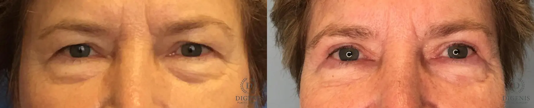 Eyelid Surgery: Patient 58 - Before and After  