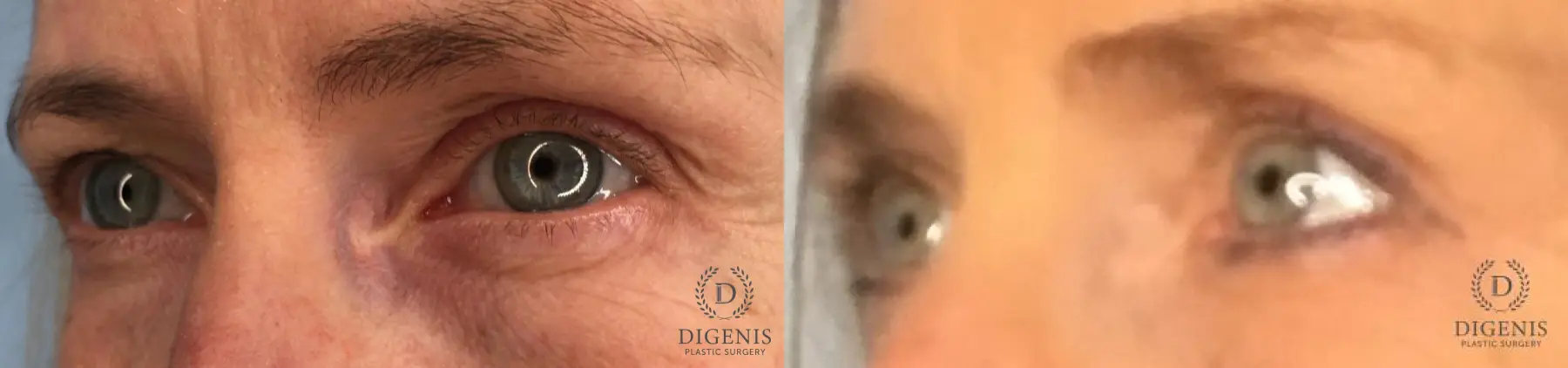 Eyelid Surgery: Patient 66 - Before and After 2