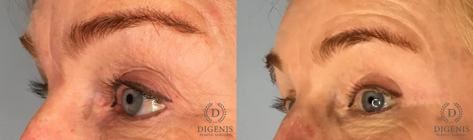 Eyelid Surgery: Patient 71 - Before and After 2