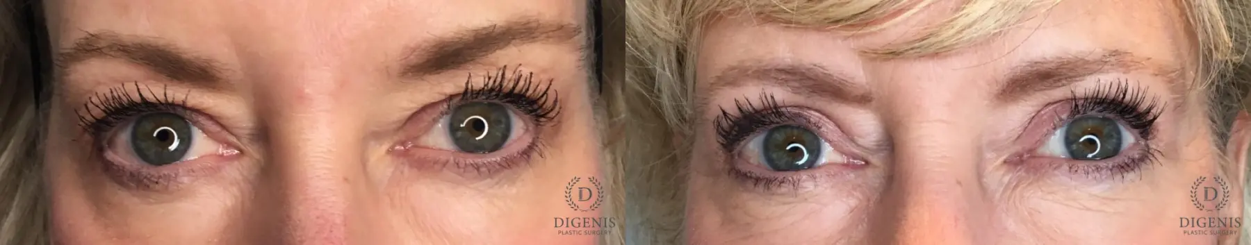 Eyelid Surgery: Patient 80 - Before and After  