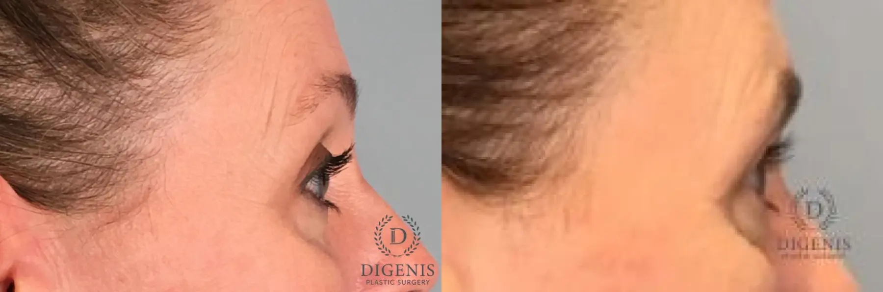 Eyelid Surgery: Patient 12 - Before and After 3