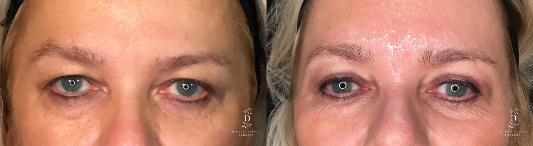 Eyelid Surgery: Patient 21 - Before and After 1